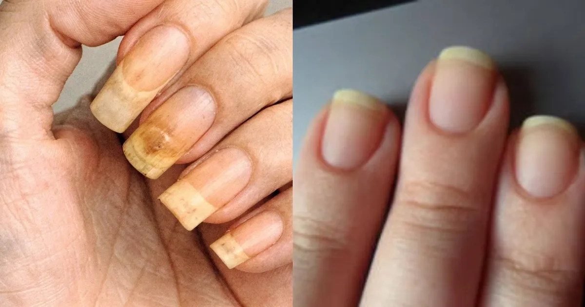 Vinagre pode melhorar a aparência de unhas amareladas, mas exige cuidados