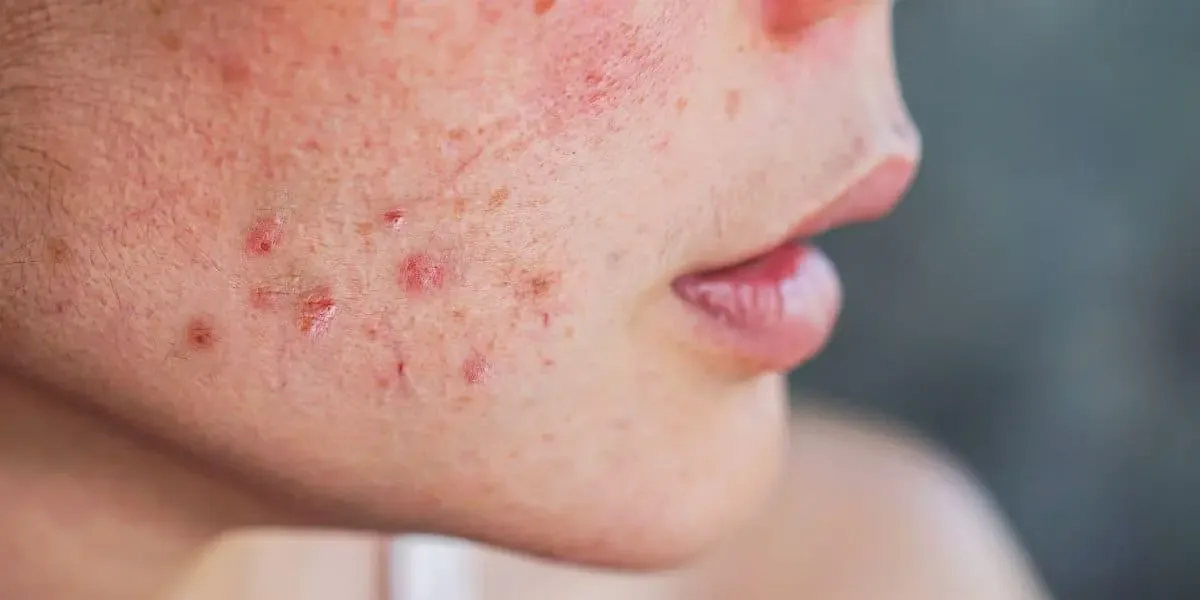Cuidados diários ajudam a evitar manchas e irritações causadas pela acne