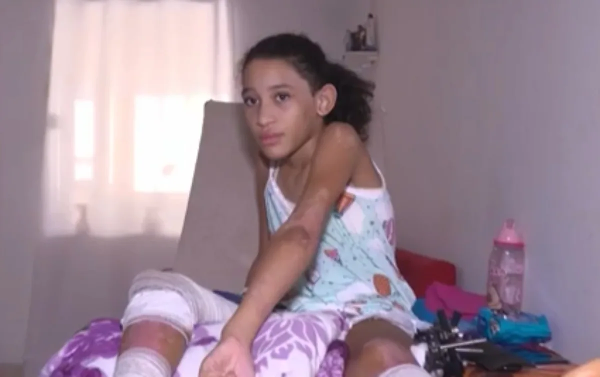 Menina de 9 anos recebe alta após explosão em Santo Antônio de Jesus