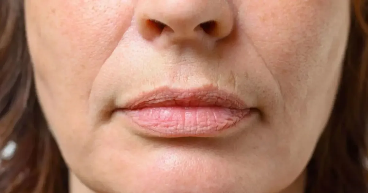 Bigode chinês: o que ajuda a evitar o aprofundamento dos sulcos faciais