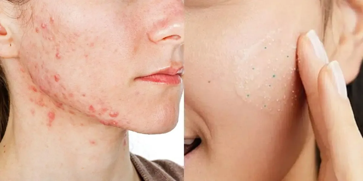 Rotina com cinco cuidados para controlar a acne e proteger a pele