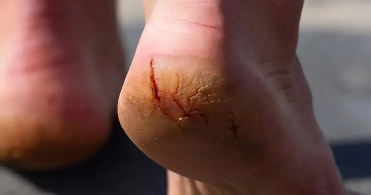 Como cuidar de pés secos e calcanhares rachados sem agredir a pele